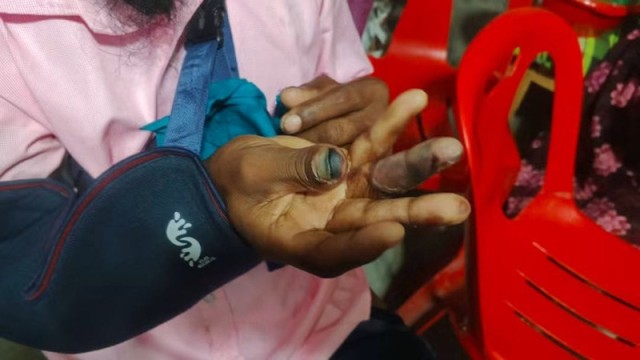 Farmer Risks Losing Finger After Using Expired Pesticide in Pabna